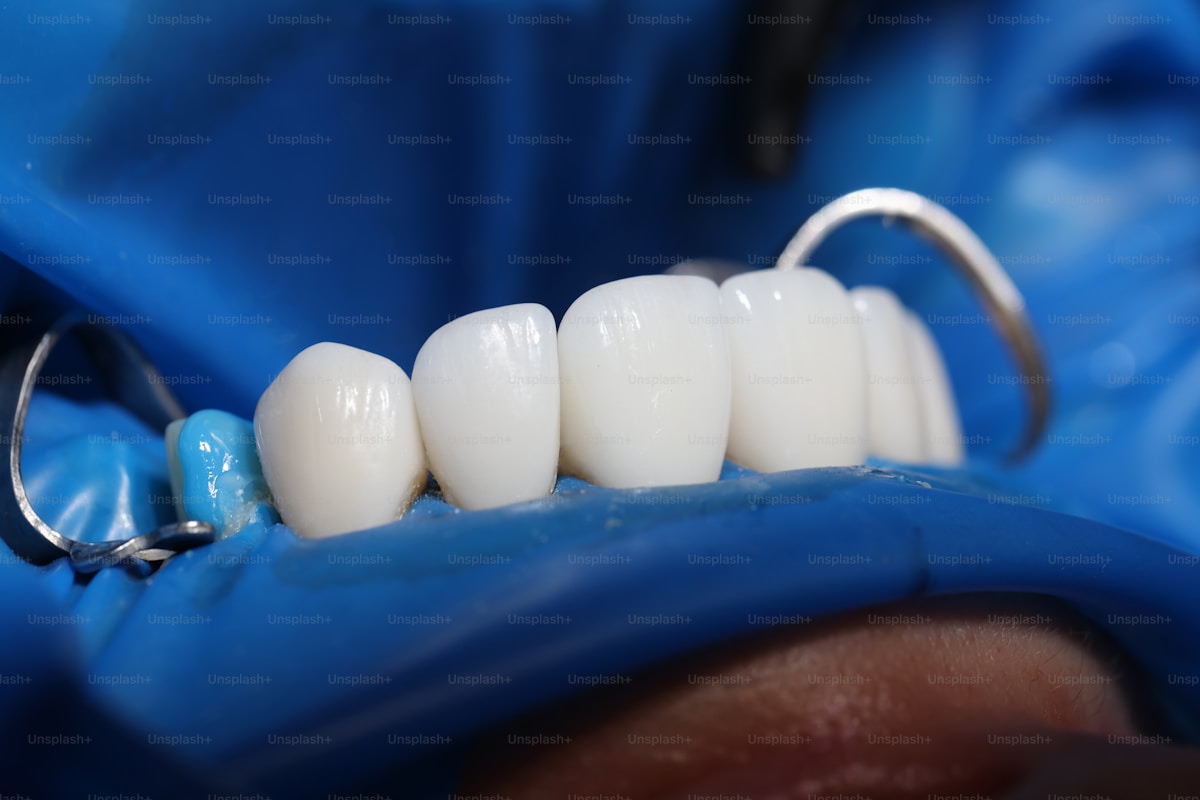 Dentist preparing a dental crown at Supreme Elite Clinic